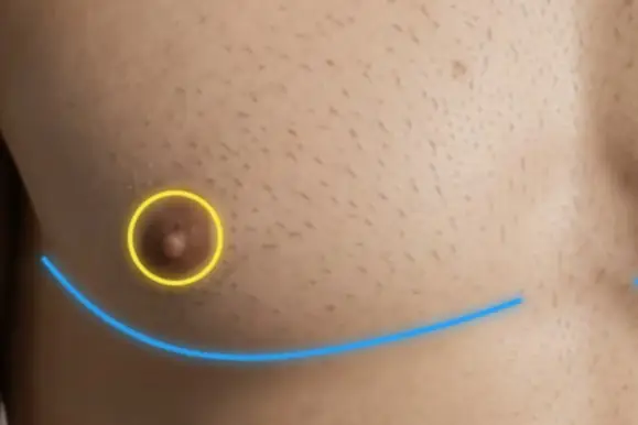 Double incision top surgery: incision along the lower chest and free nipple graft position