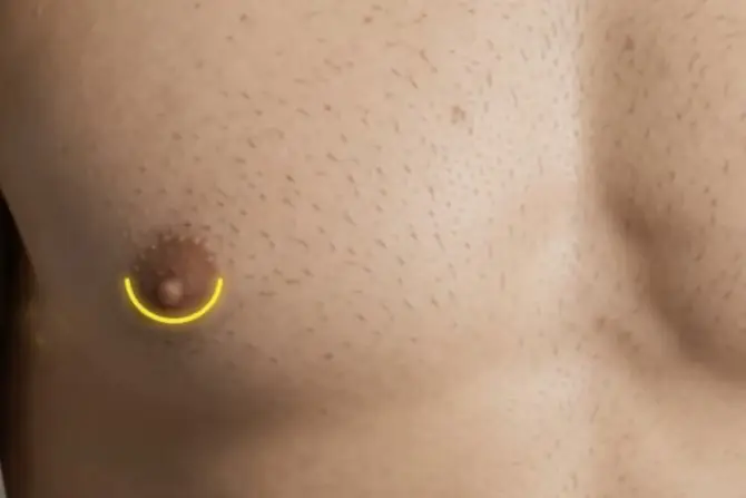 Keyhole top surgery incision along the lower areola border