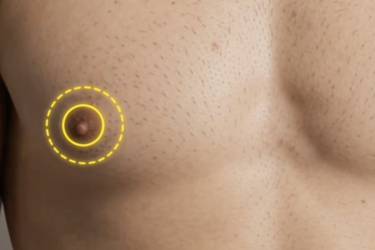 Periareolar top surgery incisions around the areola
