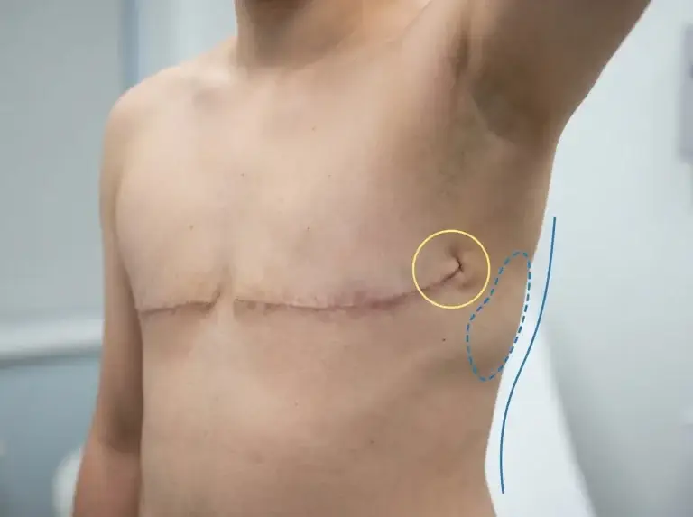 Top surgery revision: dog ear at the outer end of the scar (circled) and residual fullness at the side of the chest (dashed), with the planned corrected contour